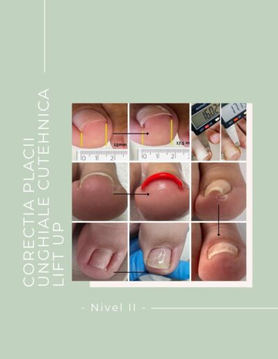 Cursul CORECTAREA PLACII UNGHIALE CU TEHNICA LIFT UP – Nivel II